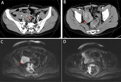 An ileal gastrointestinal stromal tumor misdiagnosed as pelvic metastases from rectal cancer: a case report
